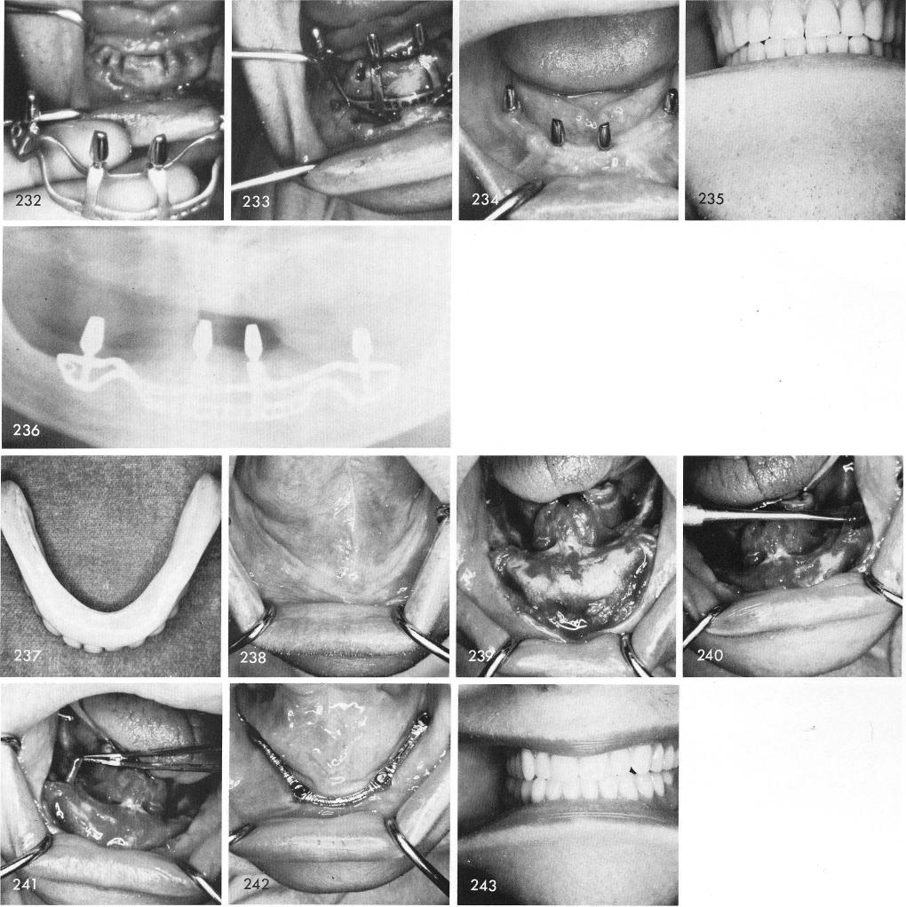 1 Subperiosteal mandibular implant strut placed in predetermined groove
