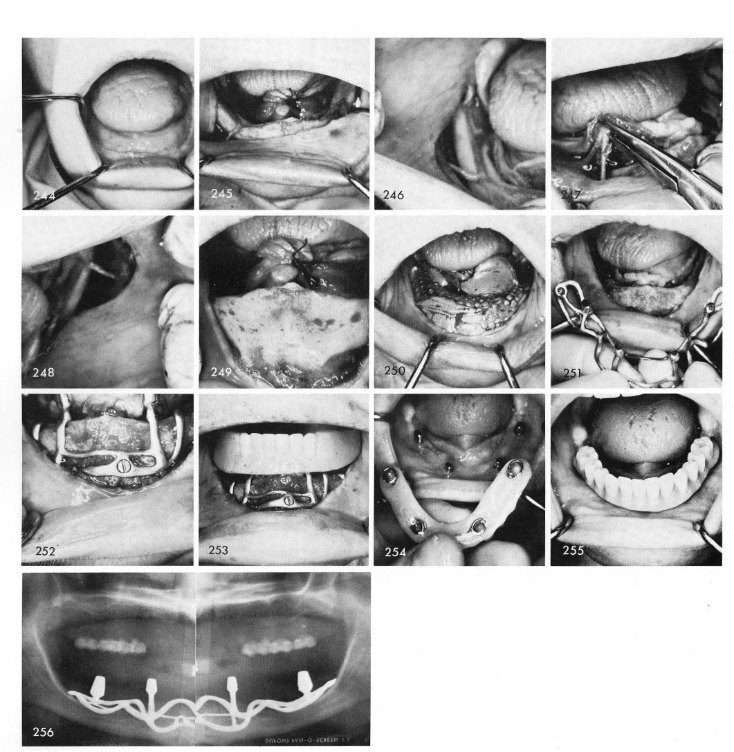 1 Nerves covered with tin foil and mandibular impression taken