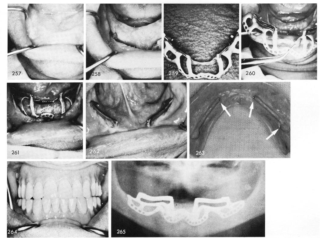 1 Mandibular prosthesis depression anterior,posterior,lingual to bar 
