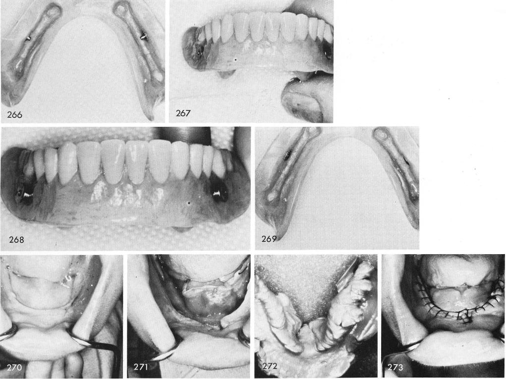 1 Horizontal attachment pushed through hole in bar of mandibular implant