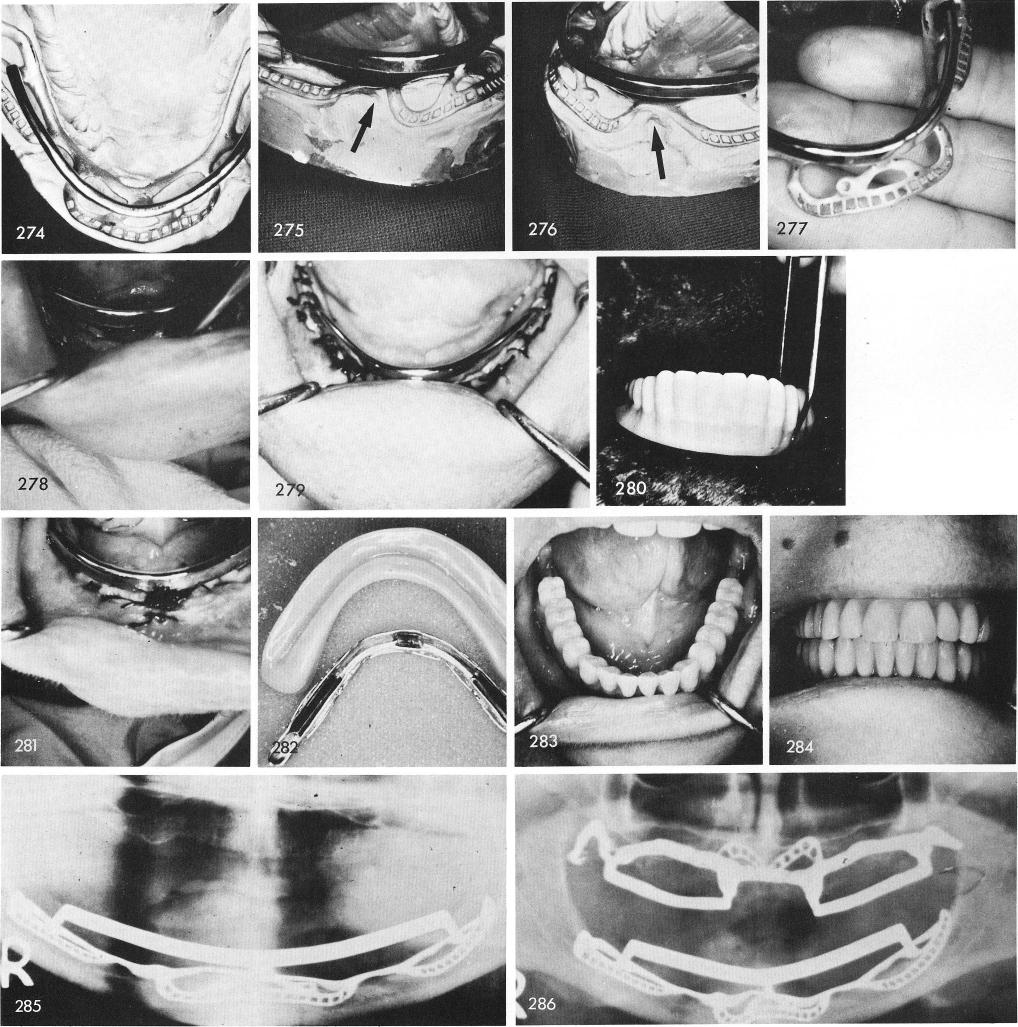 1 Mandibular implant denture with metal substructure and internal clips