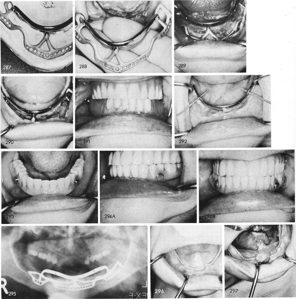 1 Inferior alveolar and mental nerves exposed in mandibular ridge