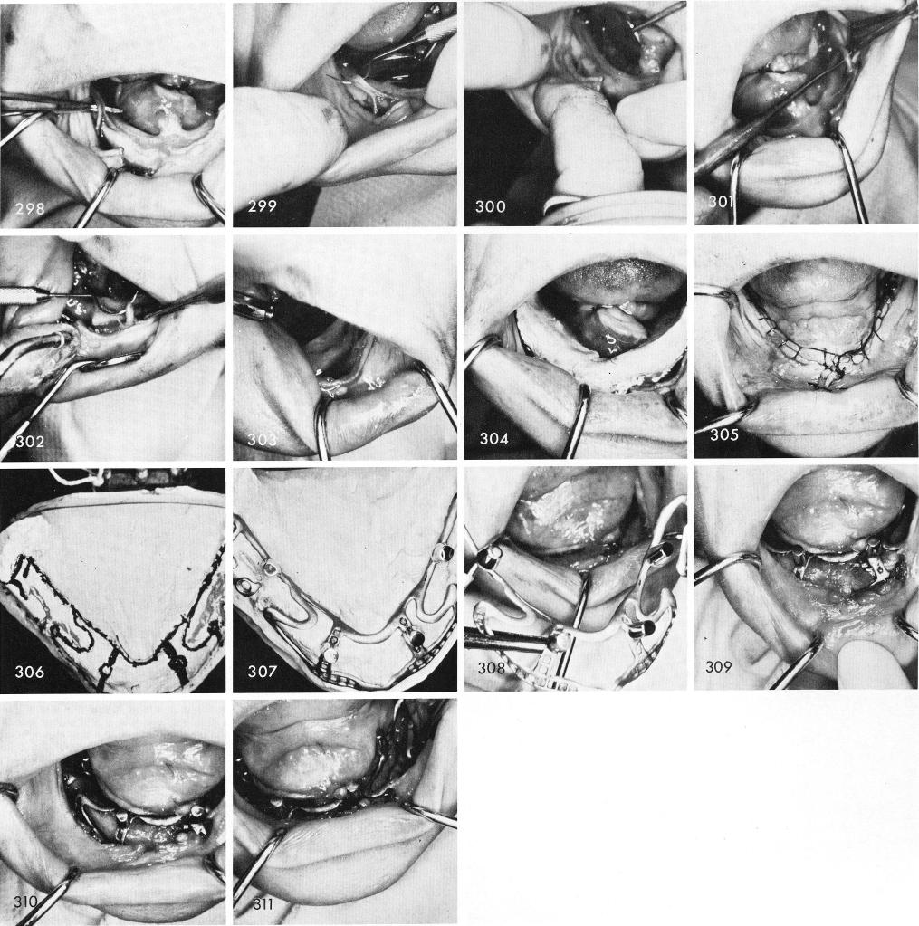1 Subperiosteal implants designed with no cross struts over nerve area