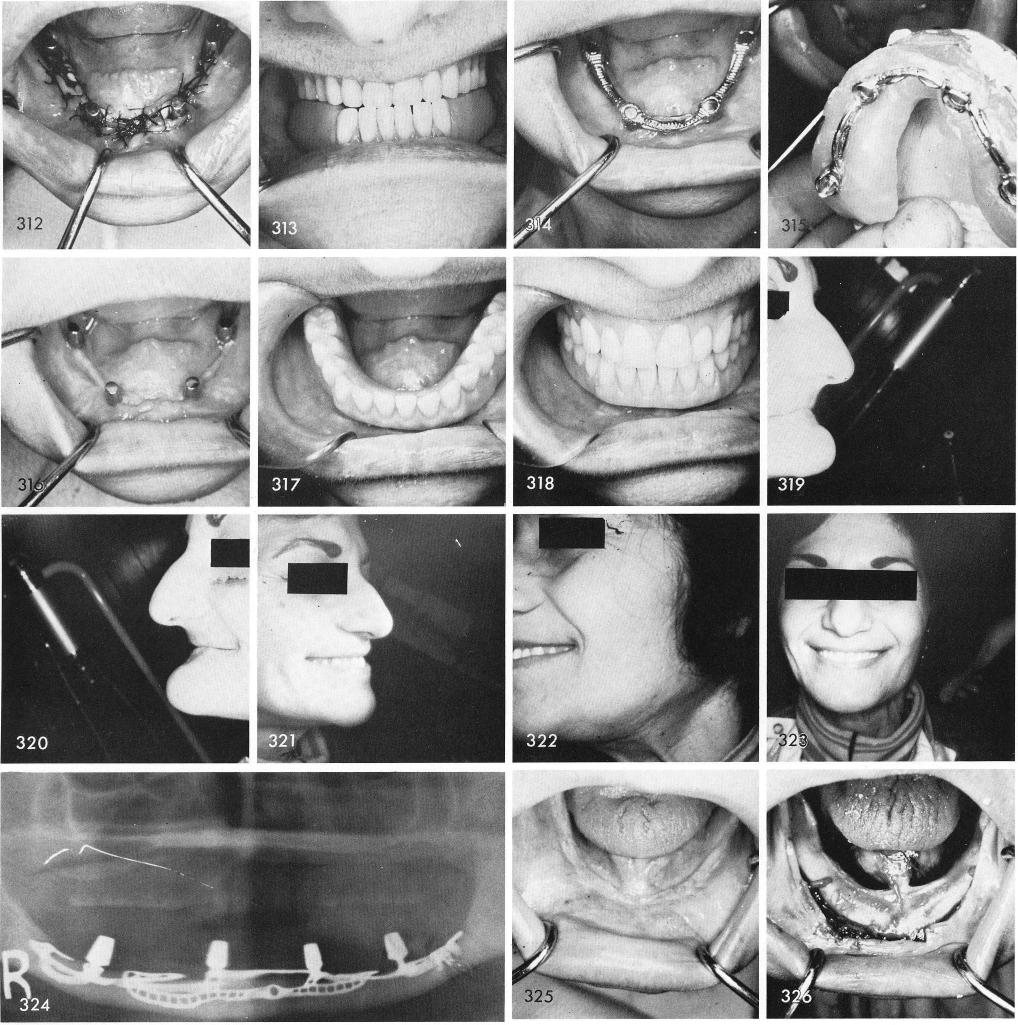 1 Heavy and light Citricon impression of resorbed mandible 