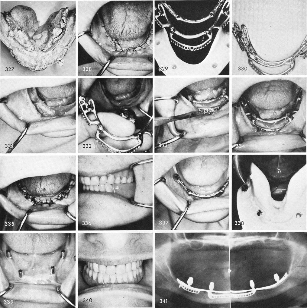 1 Mandibular implant with open area and no cross over strut distally