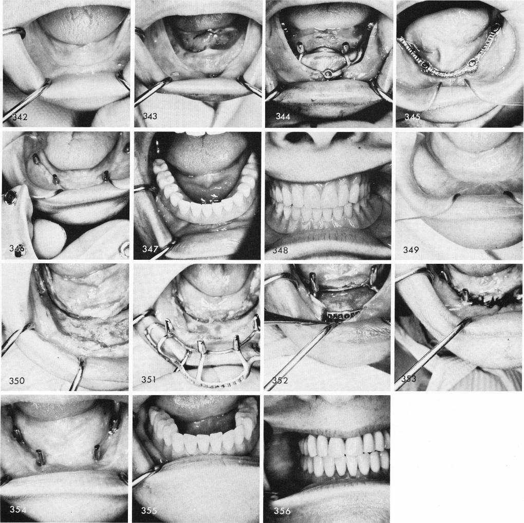 1 Inferior peripheral strut is highest area of mandibular implant