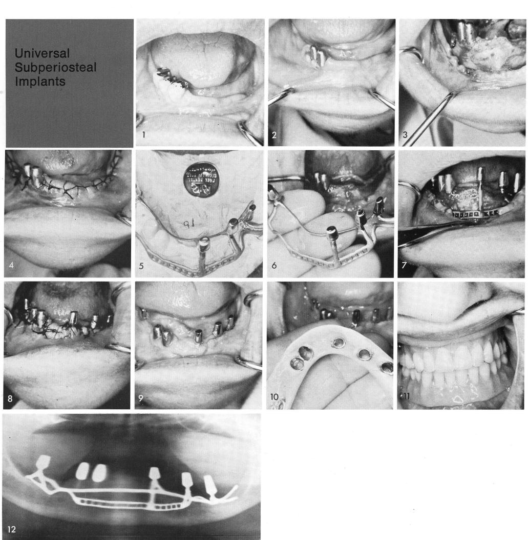 1 Gold copings on teeth before mandibular subperiosteal implantation