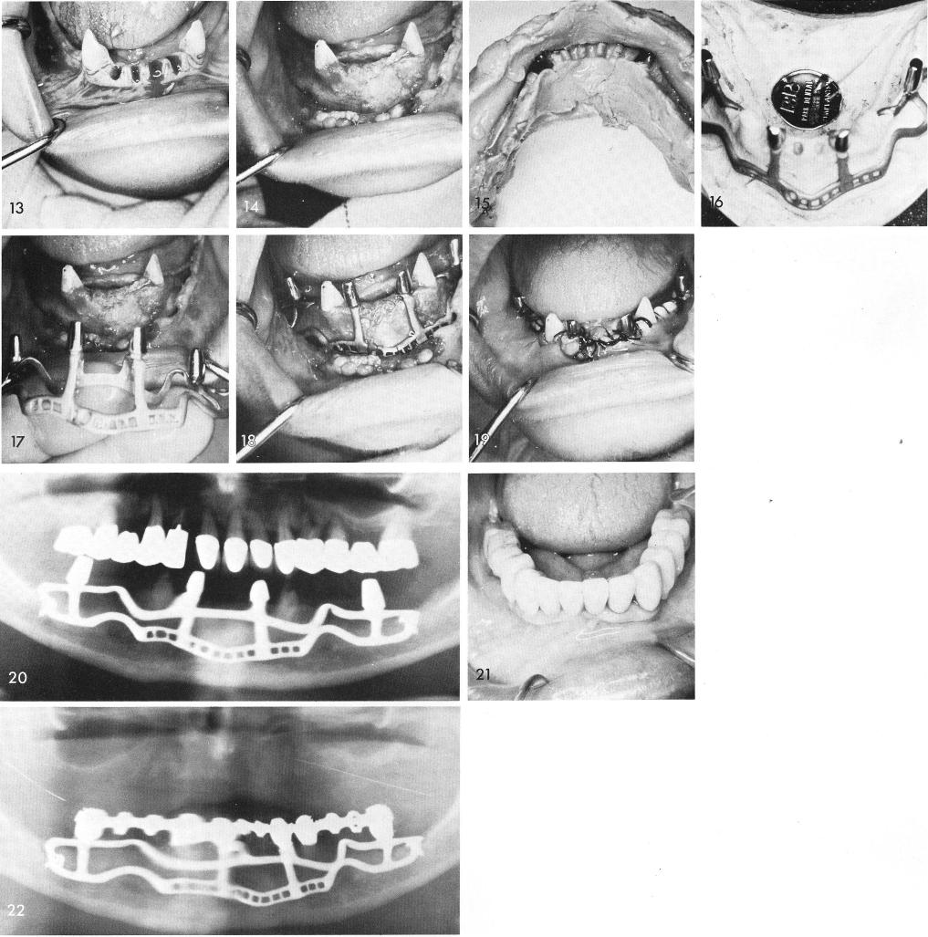 1 The mandibular subperiosteal implant is fitted over the bone