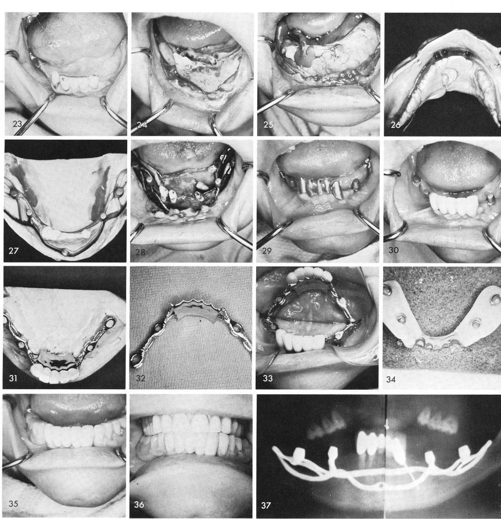 1 Mental foramen lies close to the mandibular ridge crest