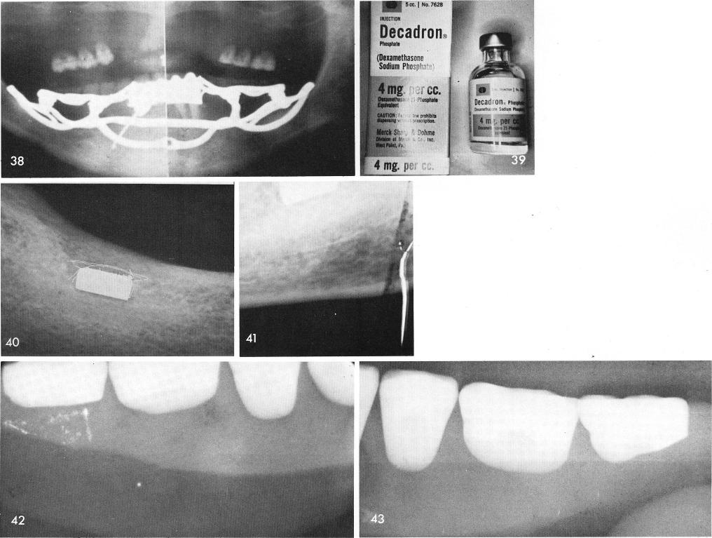 1 Decadron Phosphate intramuscularly after surgery reduces the swelling