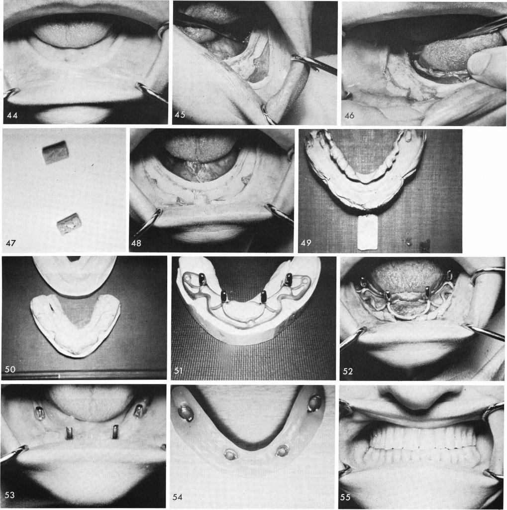 1 Exposing mental bundles and magnet implanted areas in the mandible