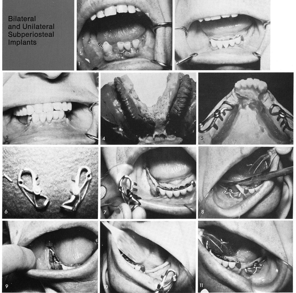 1 Partial fixed bridge in mandible with cantilevered pontic at each end