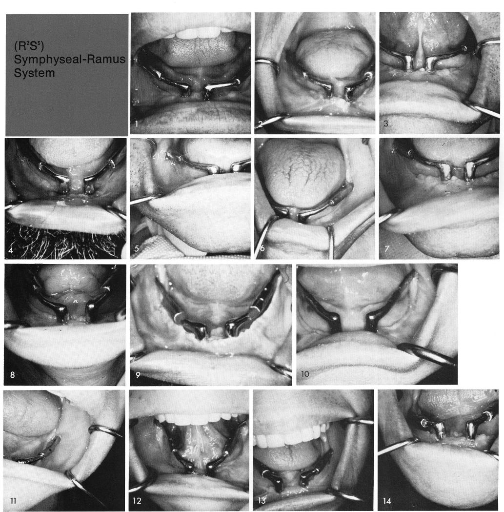 1 Five piece symphyseal ramus system