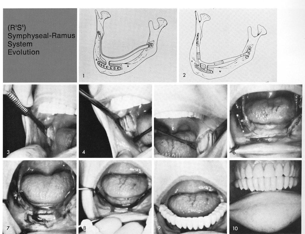 1 Robert`s original ramus frame implant
