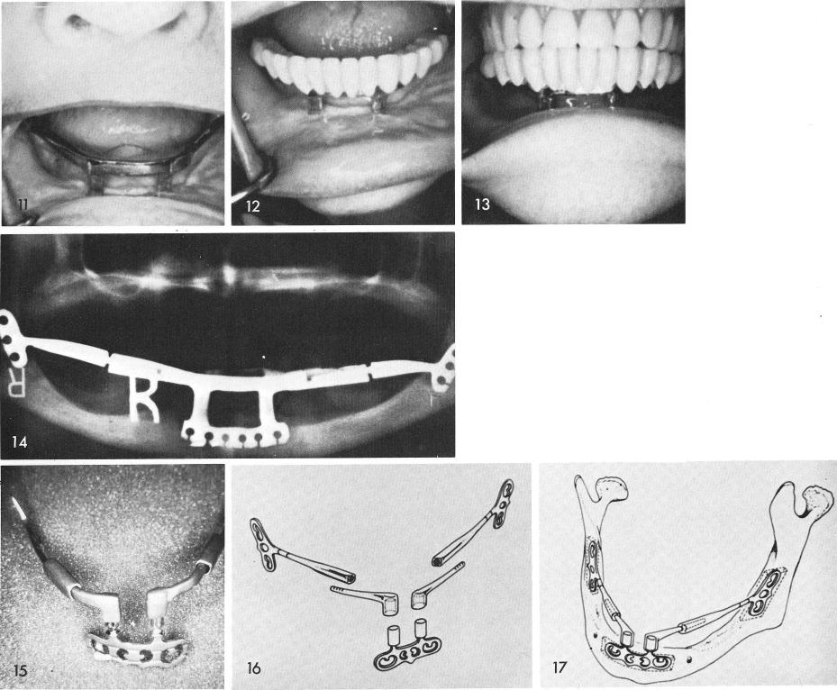 1 Acrylic splint fixed on mandibular implant with Duralay acrylic cement