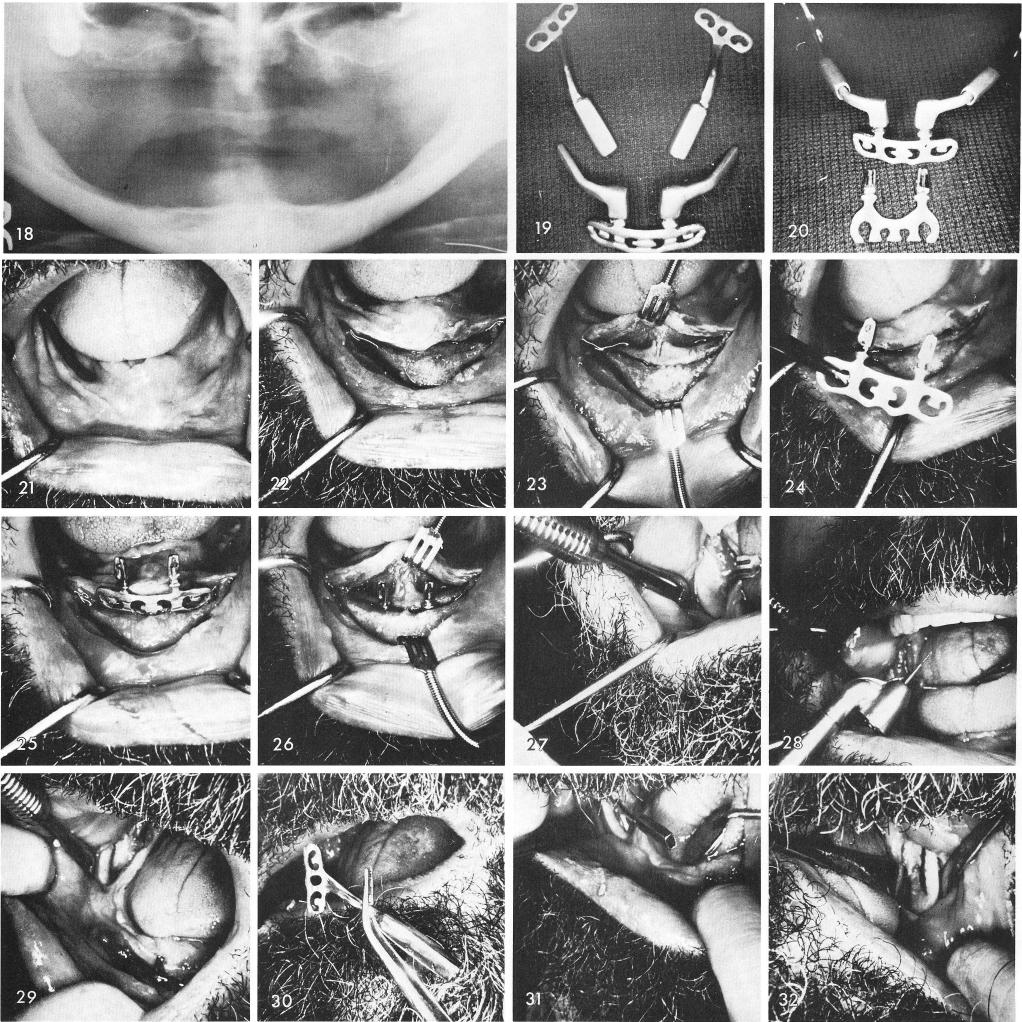 1 Five piece symphyseal ramus system