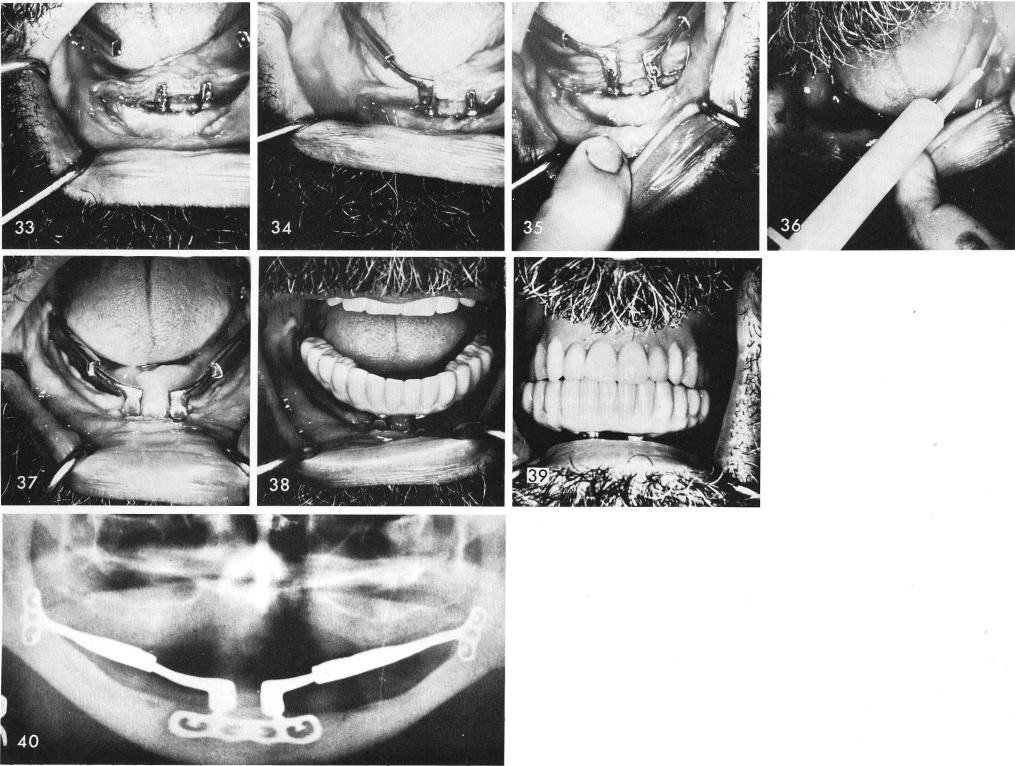 1 Hollow tube extensions from ramus part of the symphyseal ramus system