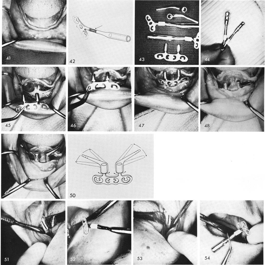 1 Aluminous porcelain neck of ramus part of symphyseal ramus system