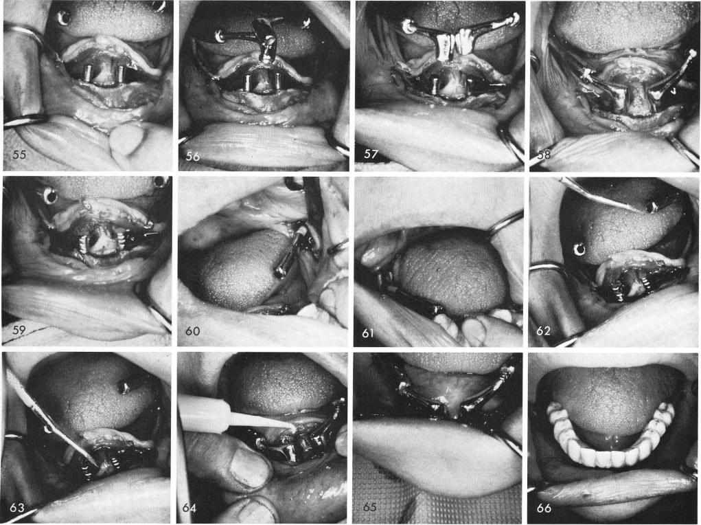 1 Tap down anterior coping for passive fit on symphyseal blade post