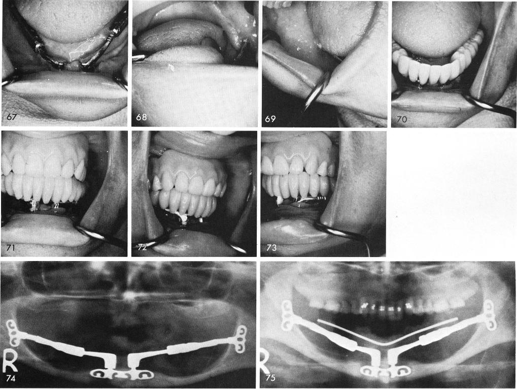 1 X-rays without and with acrylic prosthesis on symphyseal ramus system