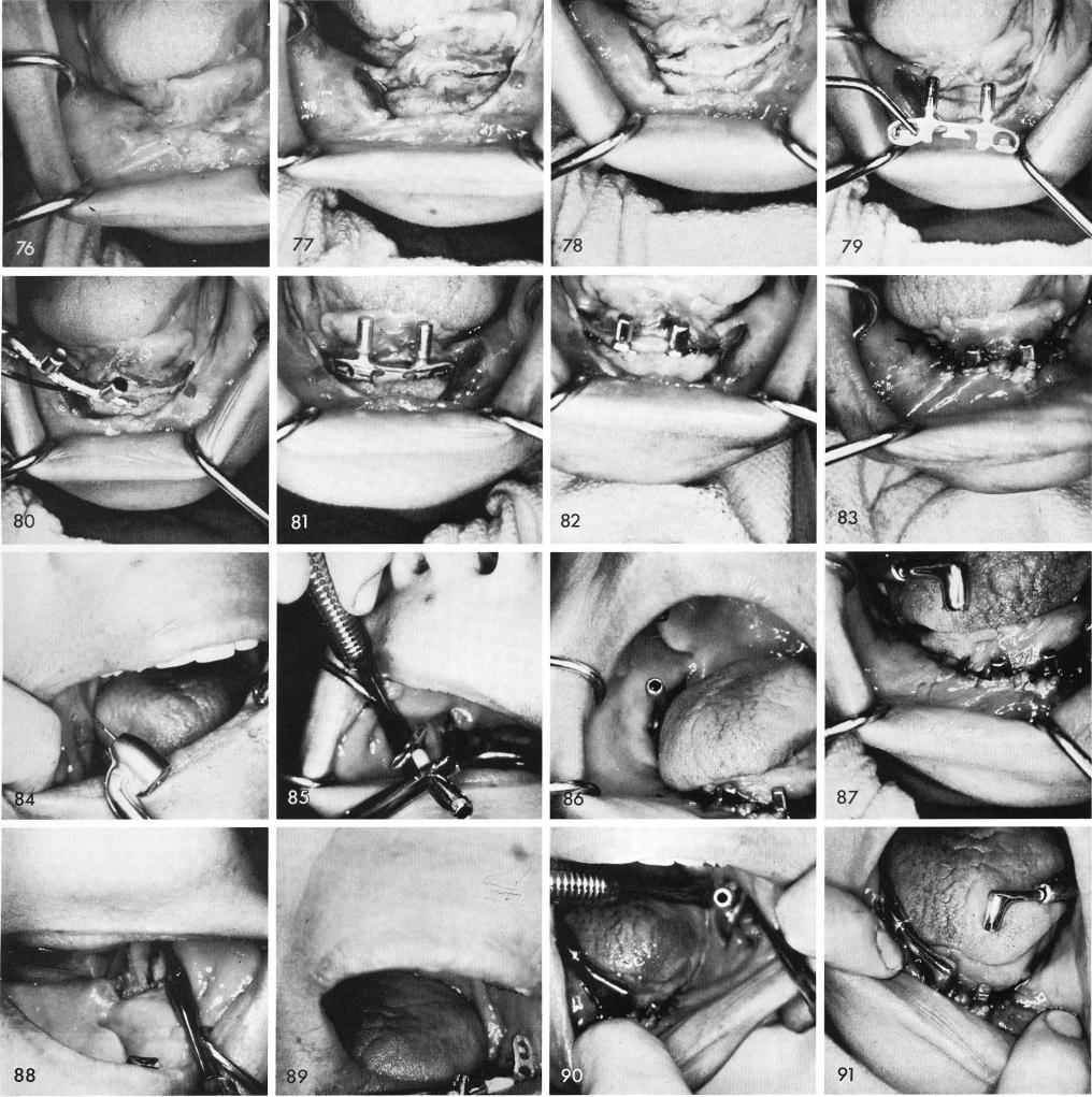 1 Mandibular blade of the symphyseal ramus system placed anteriorly