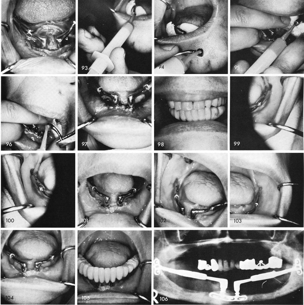 1 Acrylic splint cold cured over symphyseal ramus system