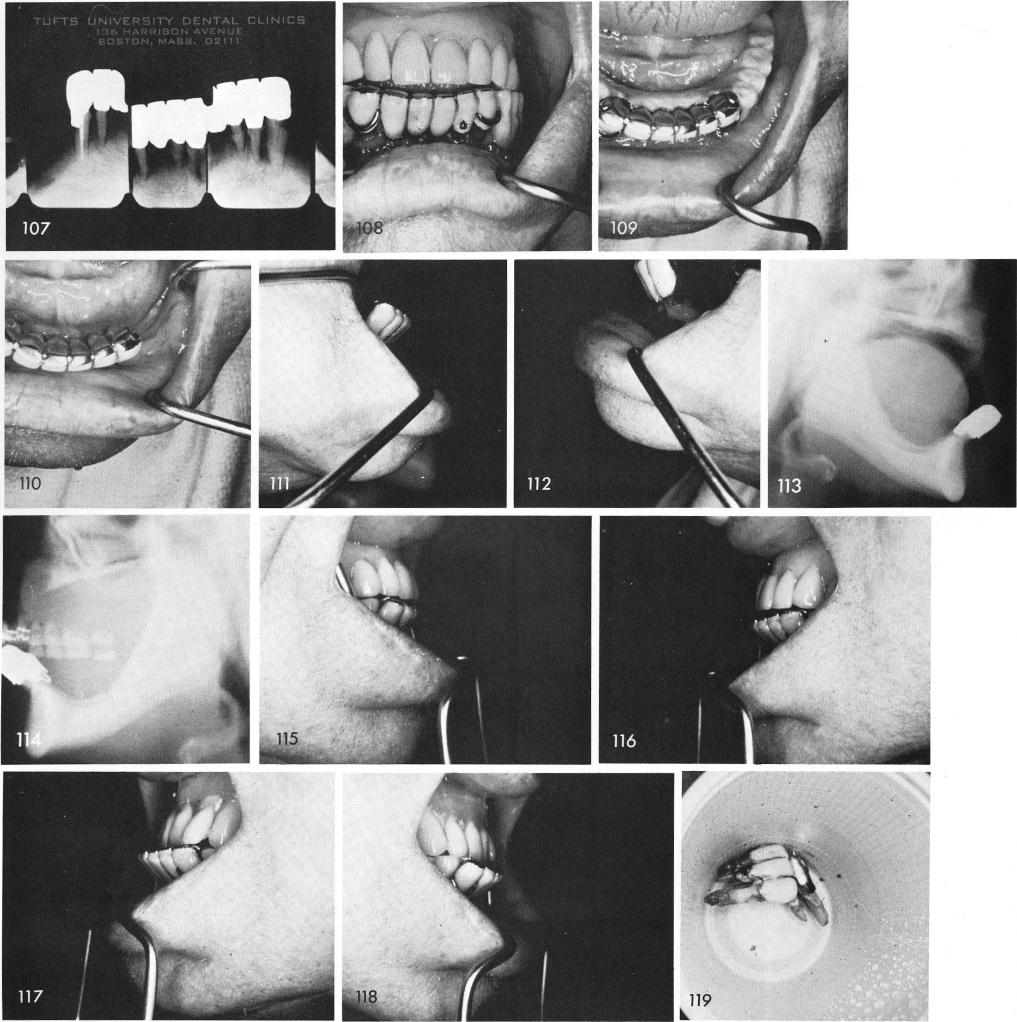 1 Labial flaring of mandibular anterior teeth