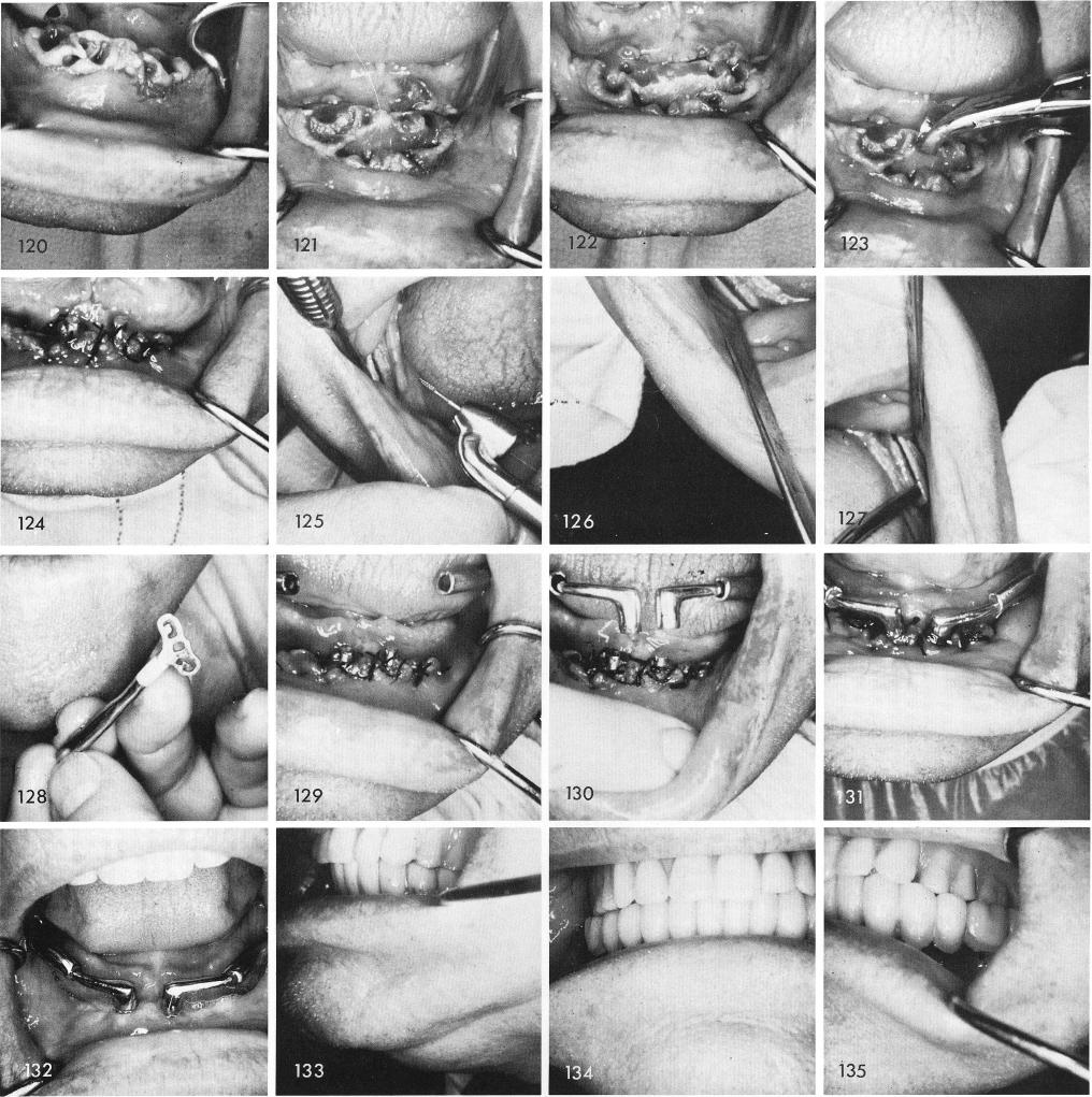 1 Widening of mandibular ridge for symphyseal bladevent implantation