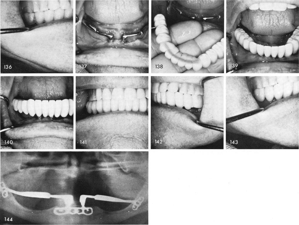 1 Clinical view of symphyseal ramus system three weeks postoperatively