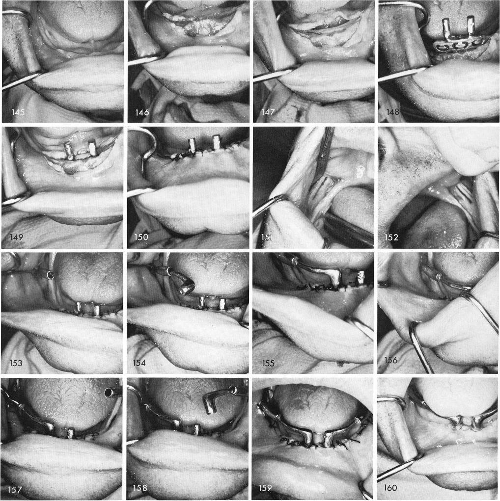 1 Widening of mandibular ridge to accomodate anterior blade implant