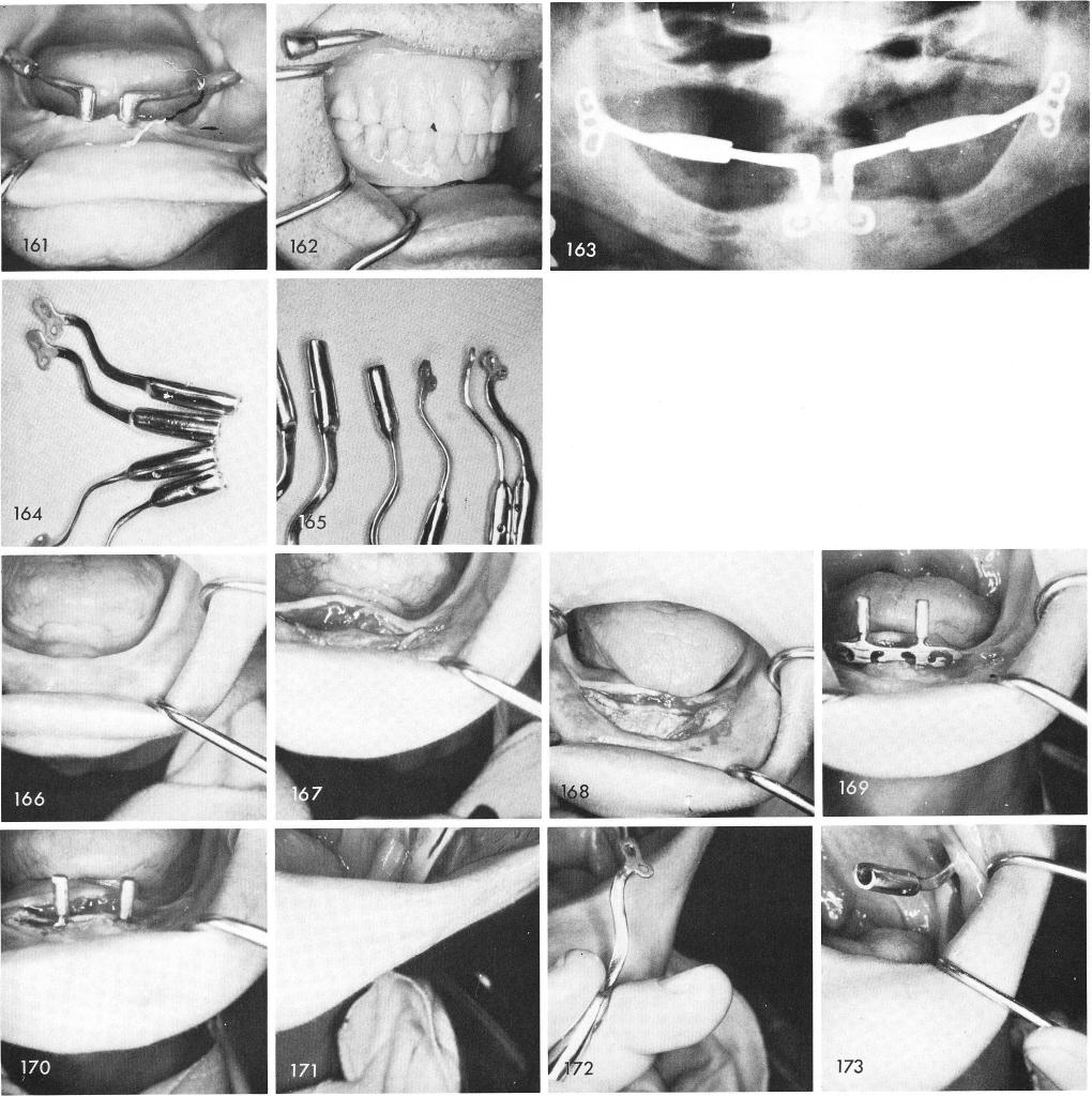 1 Superior inferior ramus implant curve eliminates occlusal prematurity