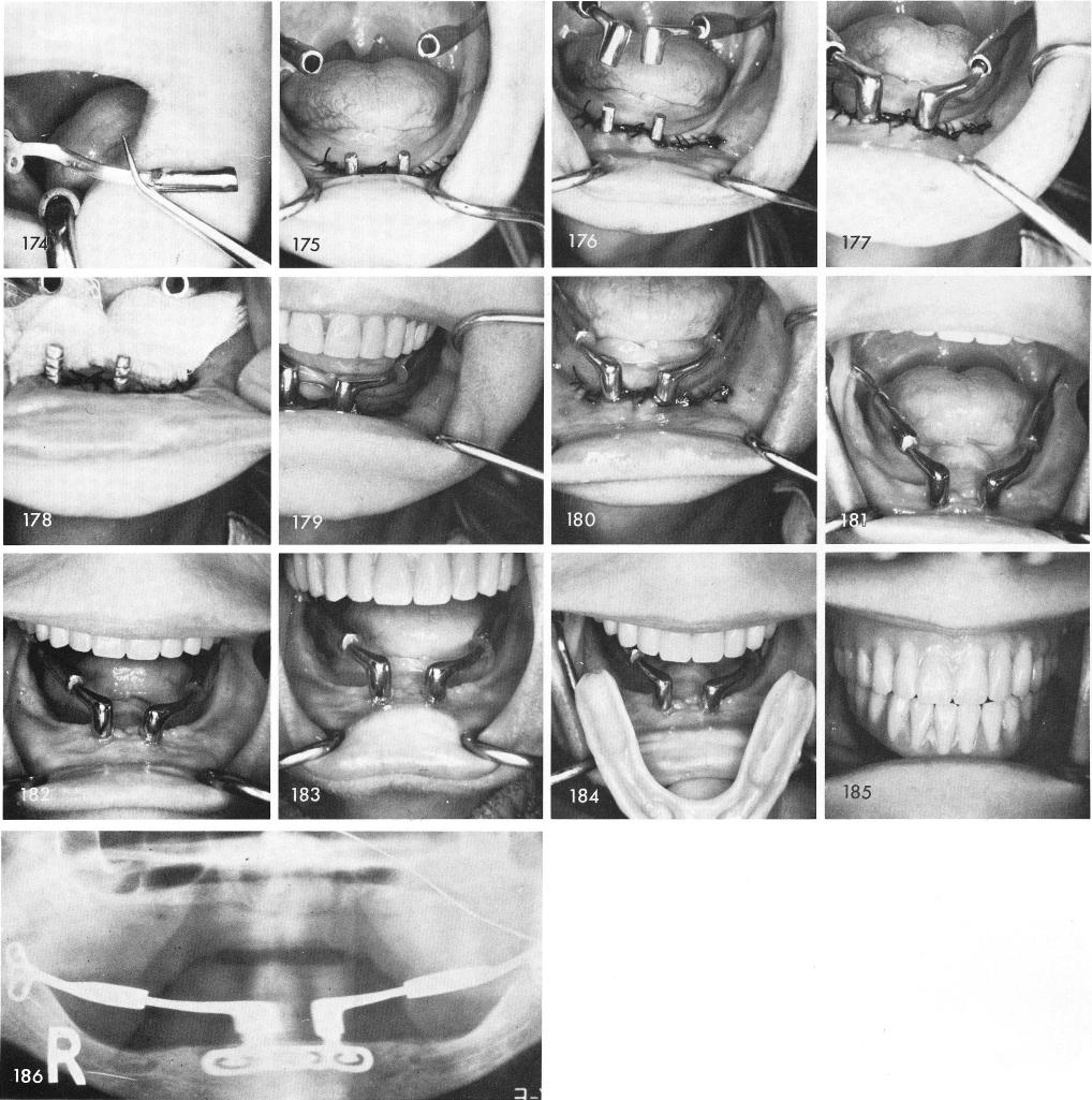 1 Post operative xray of the symphyseal ramus system