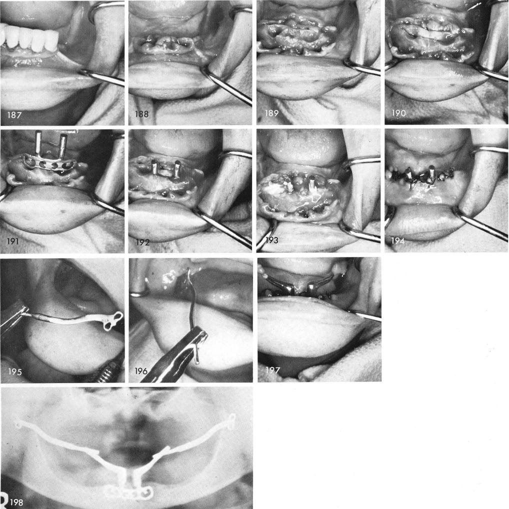 1 Extraction of periodontally involved mandibular anterior teeth