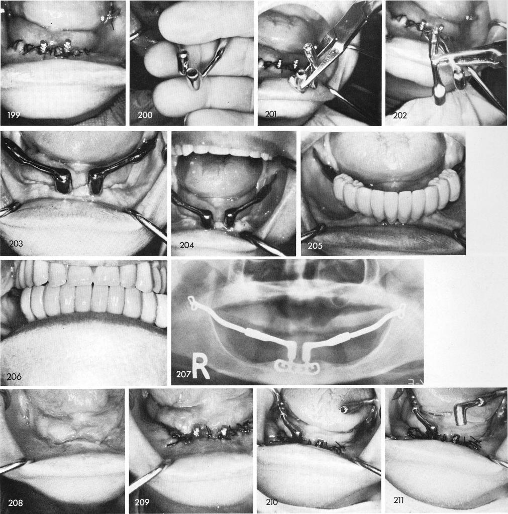 1 Anterior coping & posterior horizontal tube of symphyseal ramus system