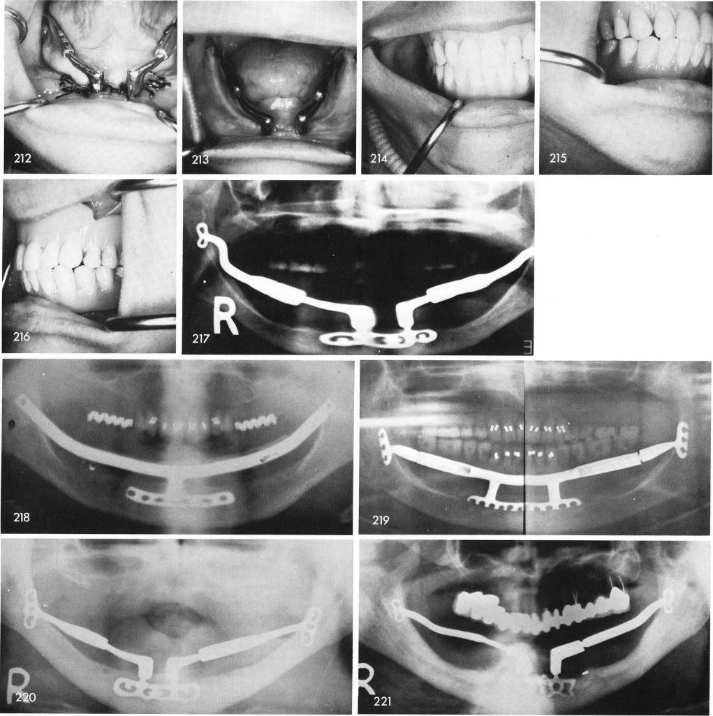 1 X ray of single frame ramus type mandibular implant