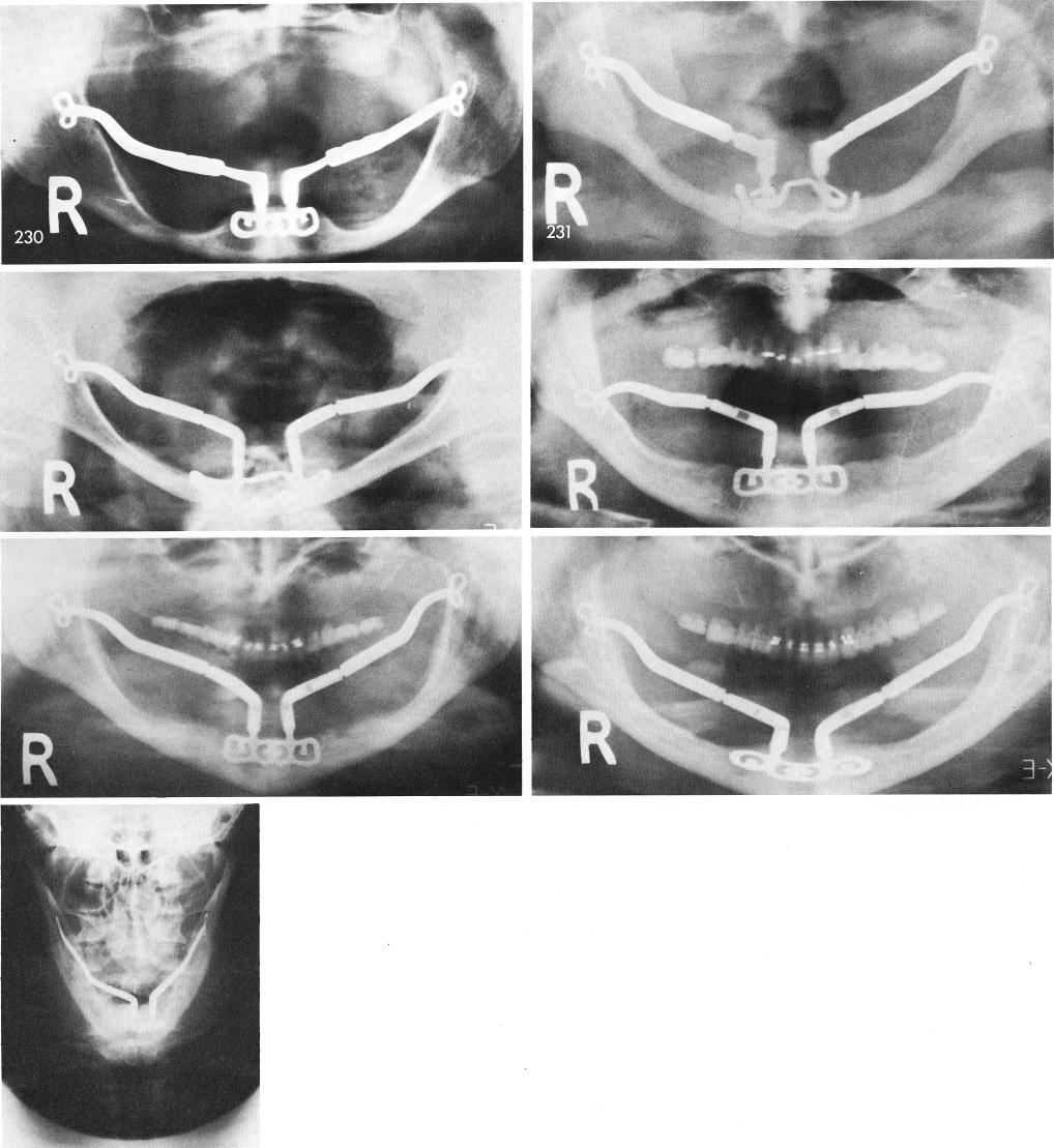 1 X rays showing five piece symphyseal ramus system