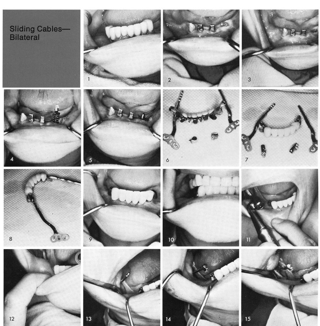 1 Replacement of mandibular cuspid with bladevent implant
