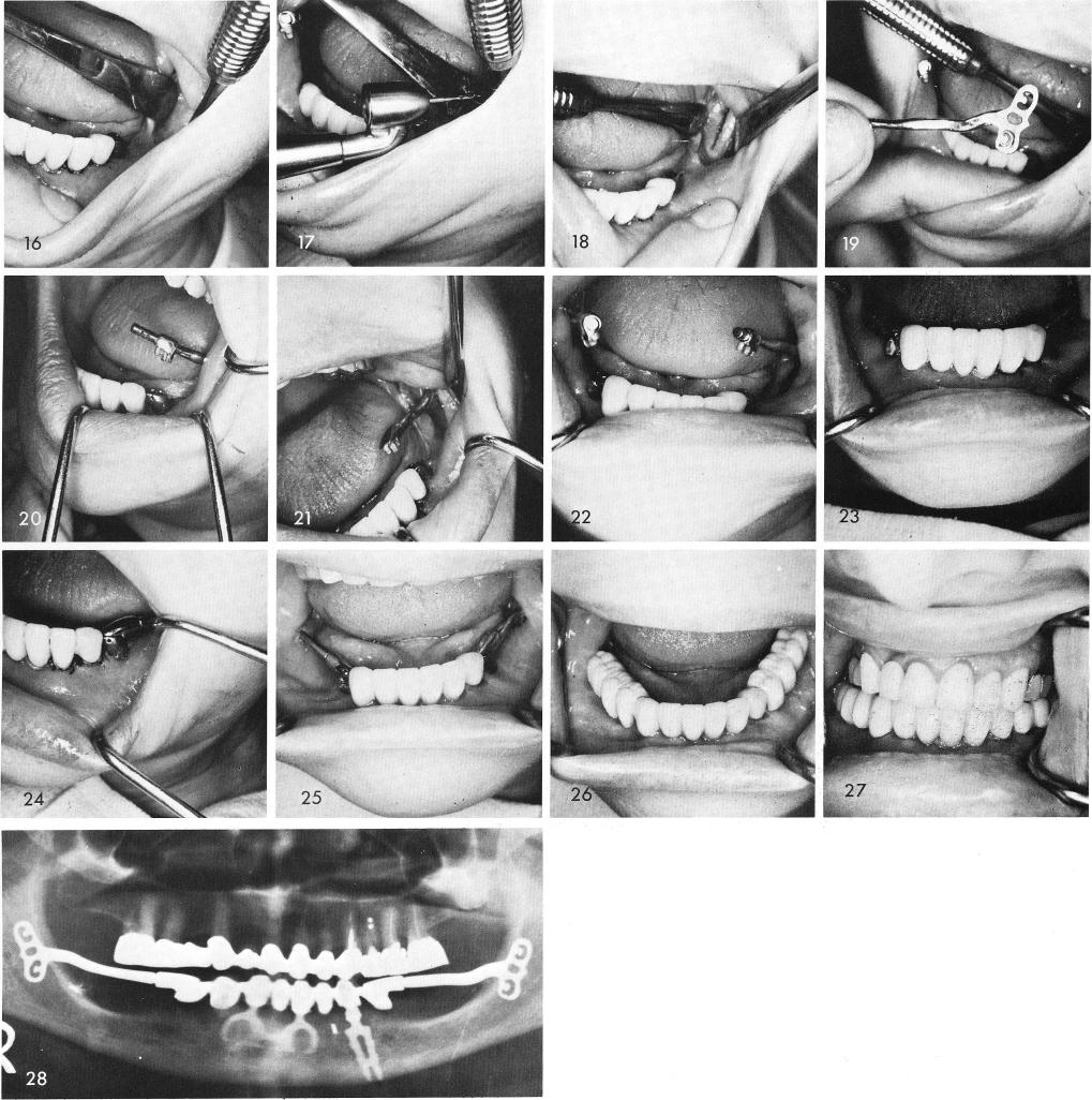 1 Hollow tube with its male figure eight lock is fitted to the cable