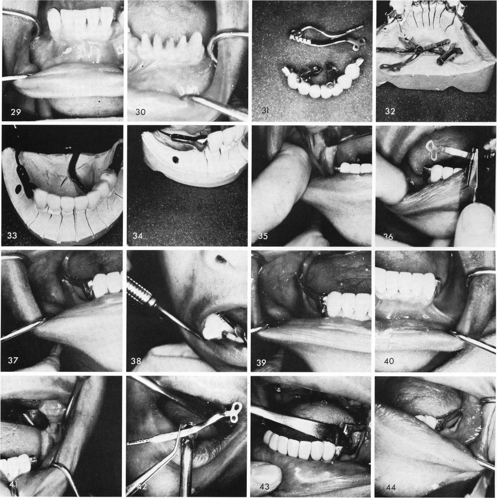 1 Ramus groove is made, ramus blade inserted, & tapped into position