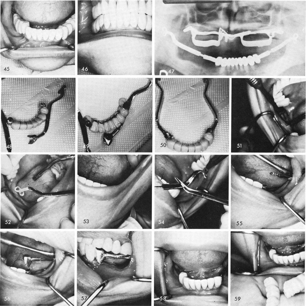 1 Sliding cable avoiding broken blade mandibular implant involvement