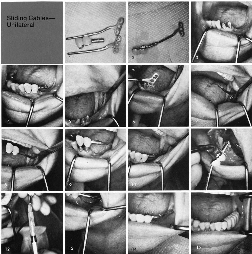 1 Mandibular anterior teeth fitted over sliding cable 