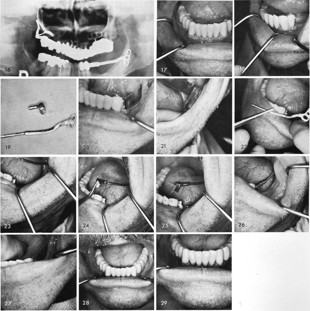 1 Mandibular fixed prosthesis with a cantilevered bicuspid 