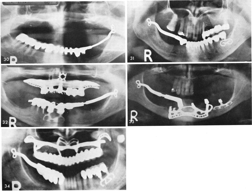 1 X-rays of unilateral mandibular sliding cables for ramus implants