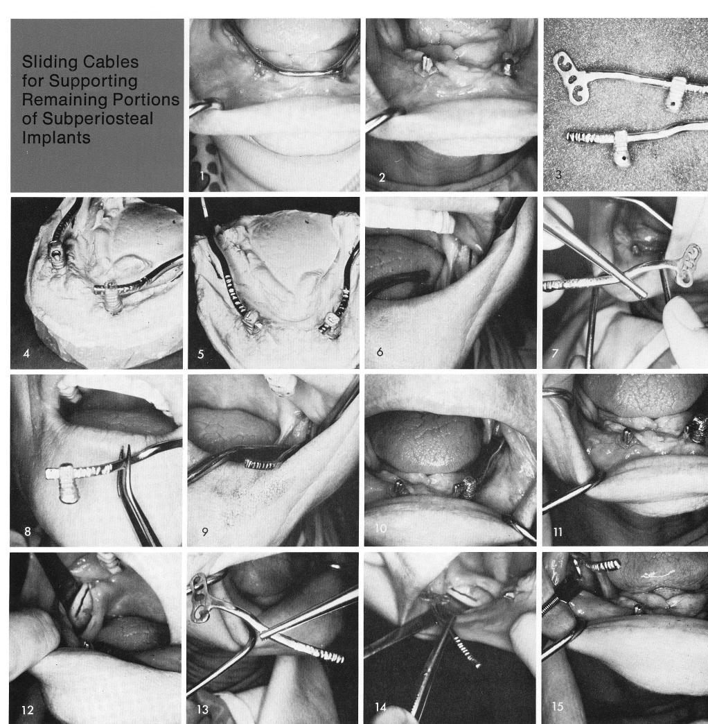 1 Mandibular subperiosteal implant with a horizontal superstructure bar