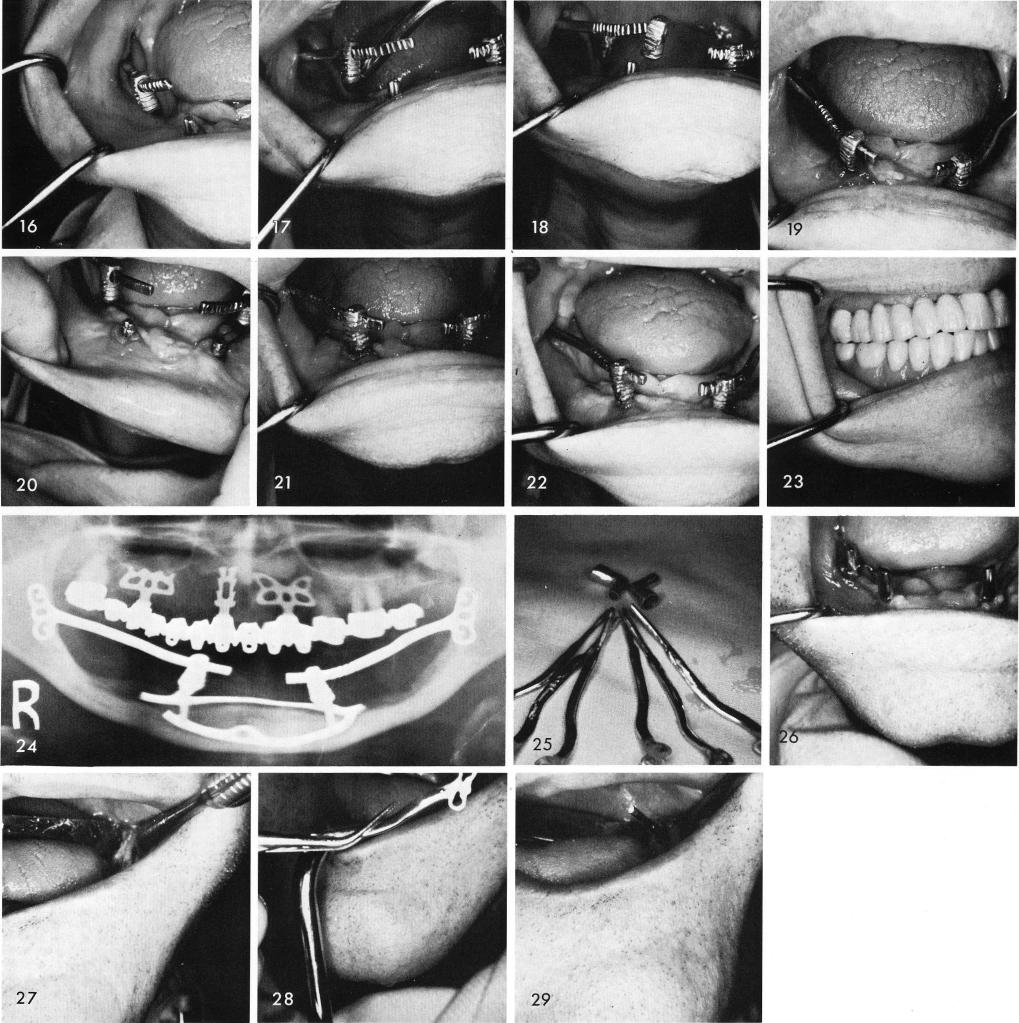 1 Prefabricated mandibular anterior copings & horizontal tube extensions
