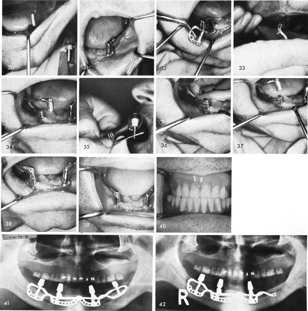 1 X rays showing healed tissues and completed mandibular implant denture 