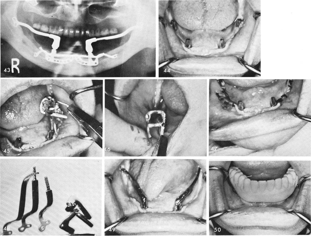 1 Failing subperiosteal mandibular implant