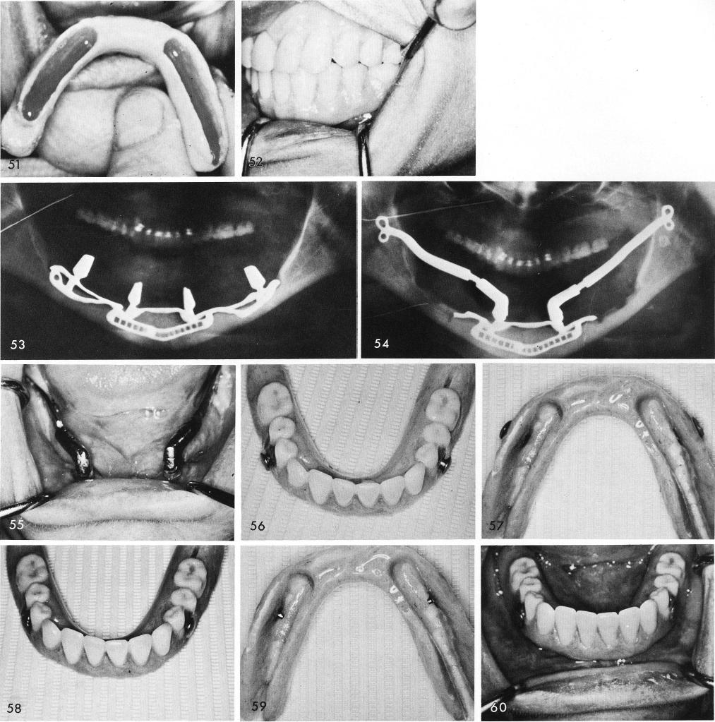 1 X ray showing final occlusion after implant and prosthesis placement