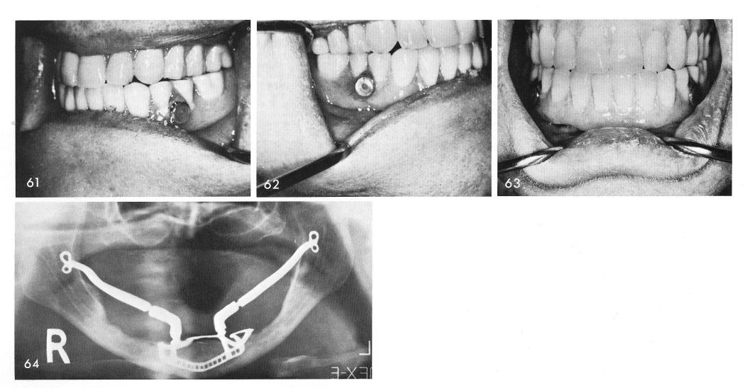 1 Post operative x rays of bilateral sliding cable implants in mandible