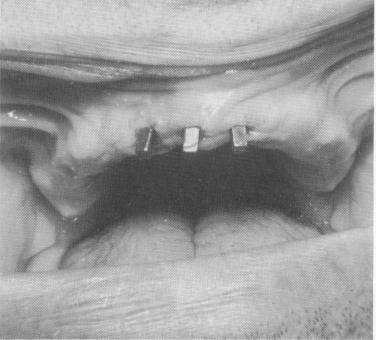 1 Clinical view of anterior vent-plant endosseous implant